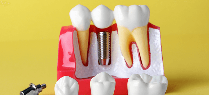 入れ歯のお悩みに対して「しっかり噛める」インプラントという選択肢