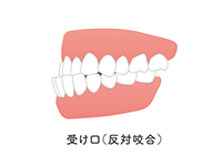 受け口（反対咬合）