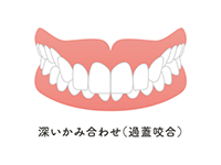 過蓋咬合（かがいこうごう）