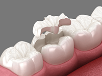 セラミックインレー