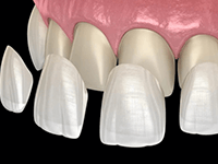 ラミネートべニア