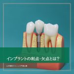 インプラントの利点・欠点とは？