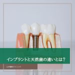 インプラントと天然歯の違いとは？