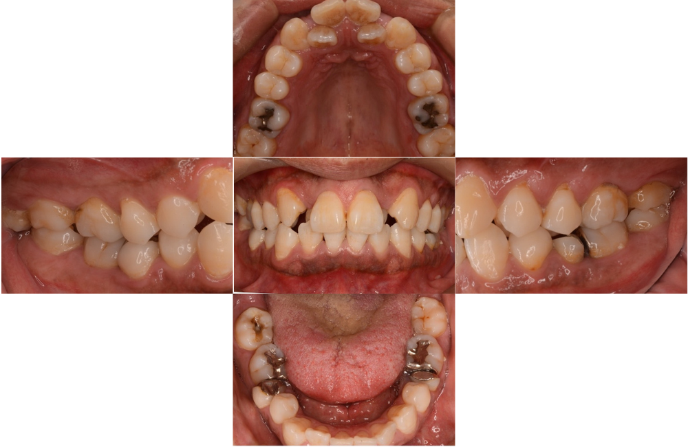 マウスピース矯正_叢生_術前