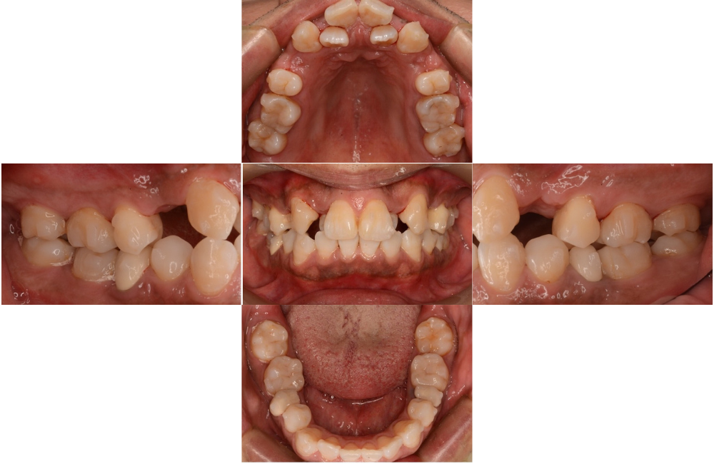マウスピース矯正_叢生_抜歯