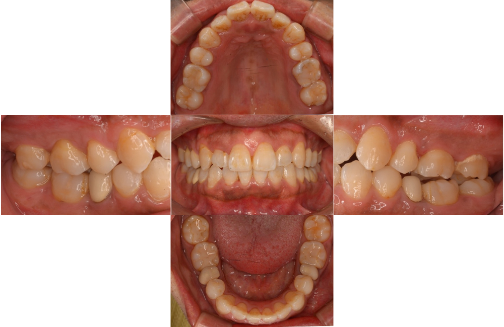 マウスピース矯正_叢生_術後