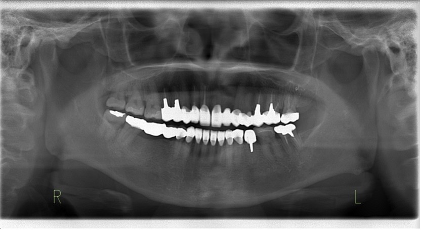 セラミック全顎治療_術後パノラマ