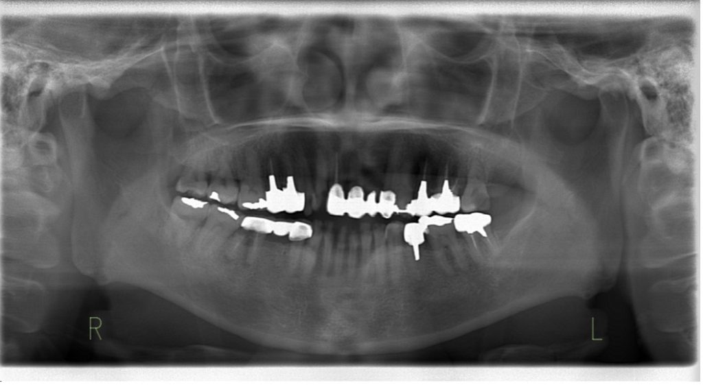 セラミック全顎_術前パノラマ