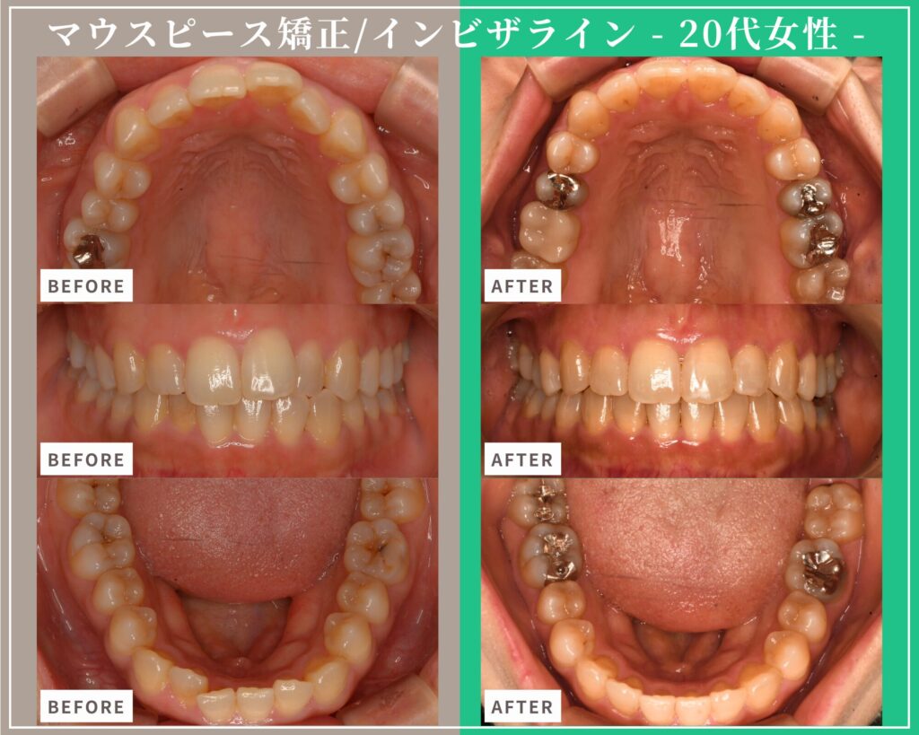 症例紹介：マウスピース型矯正治療（インビザライン）・20代女性