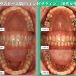 症例紹介：マウスピース型矯正治療（インビザライン）・20代女性