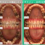 症例紹介：マウスピース型矯正治療（インビザライン）・40代女性