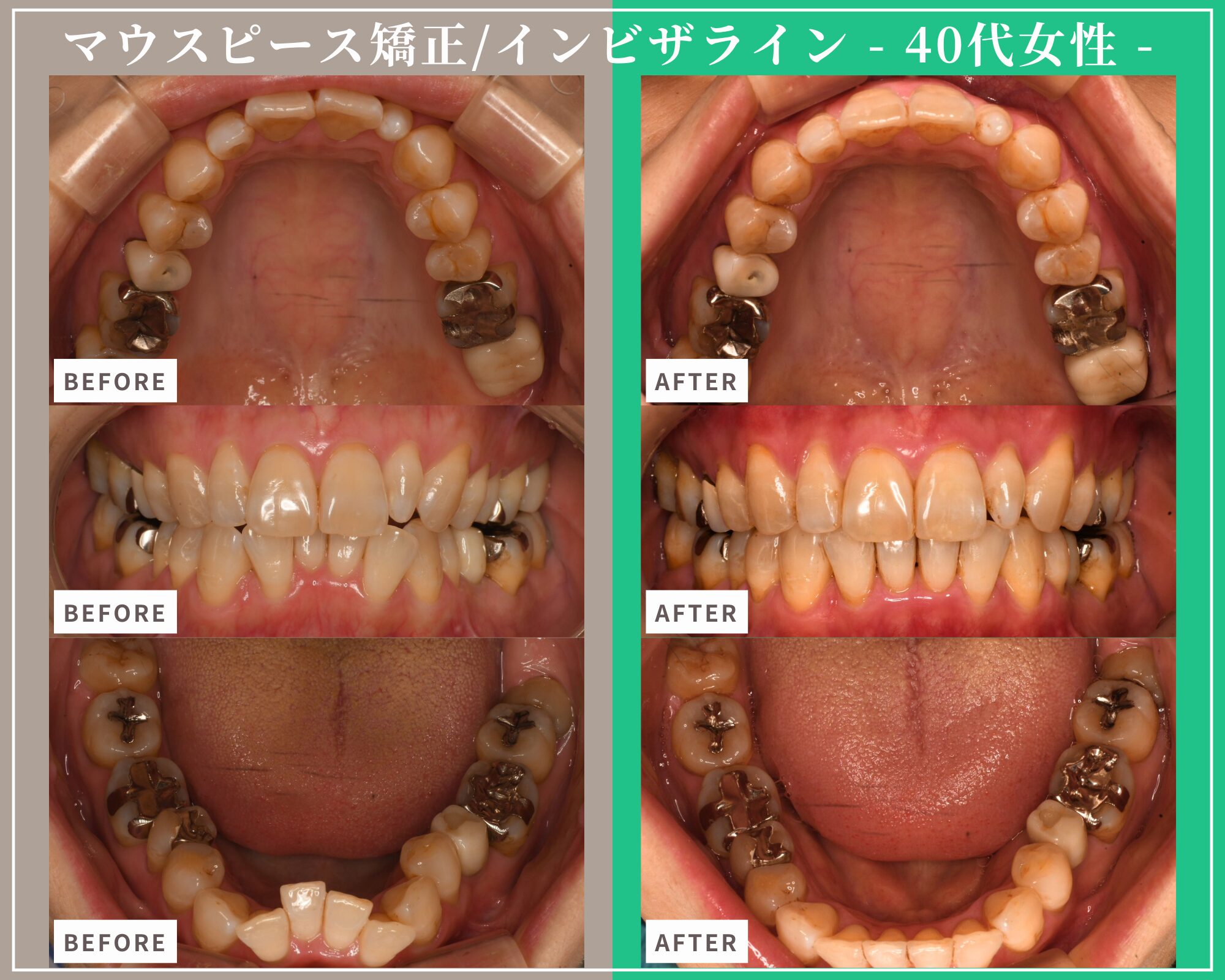 症例紹介：マウスピース型矯正治療（インビザライン）・40代女性